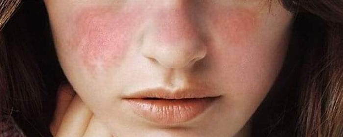 Lupus – What are the Signs and Symptoms? - Stemedix